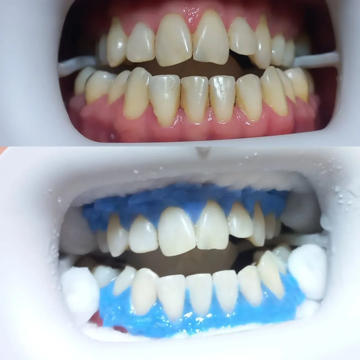 teeth2