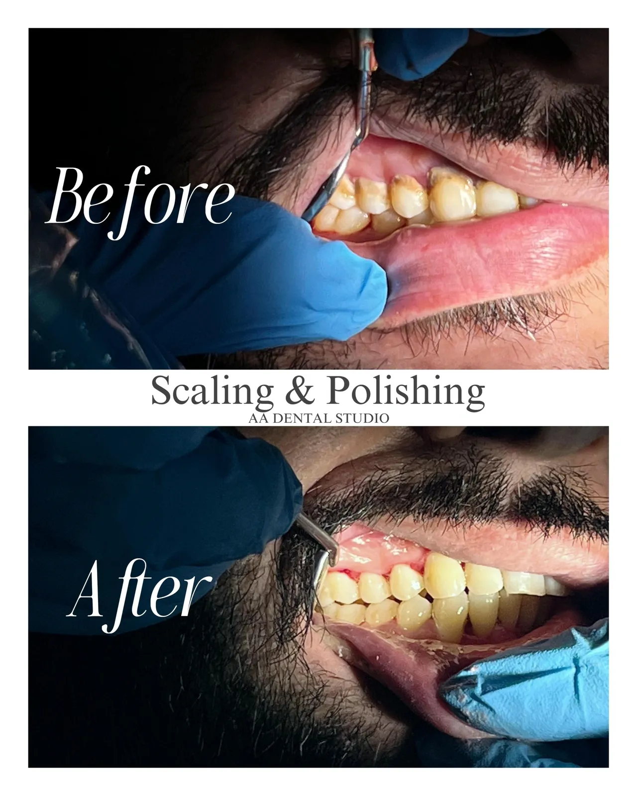 teeth3