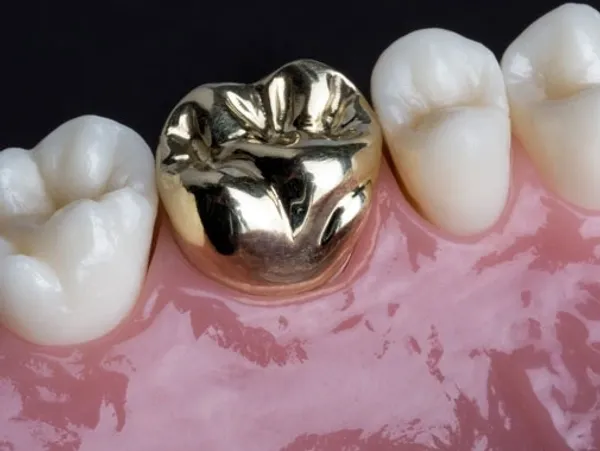 Dental Crowns