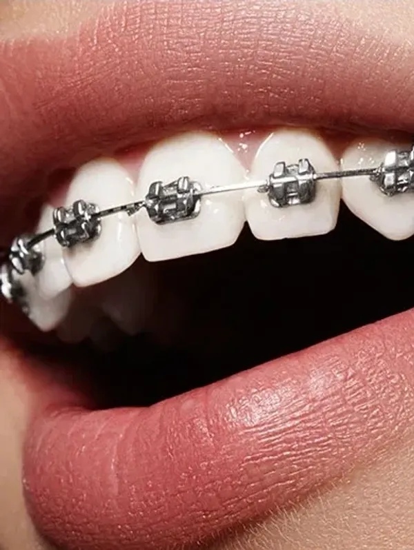 Orthodontic Treatment