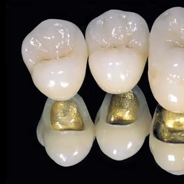 Porcelain Crowns