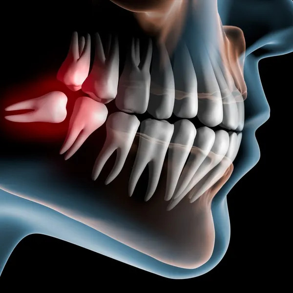 Wisdom Tooth Extraction