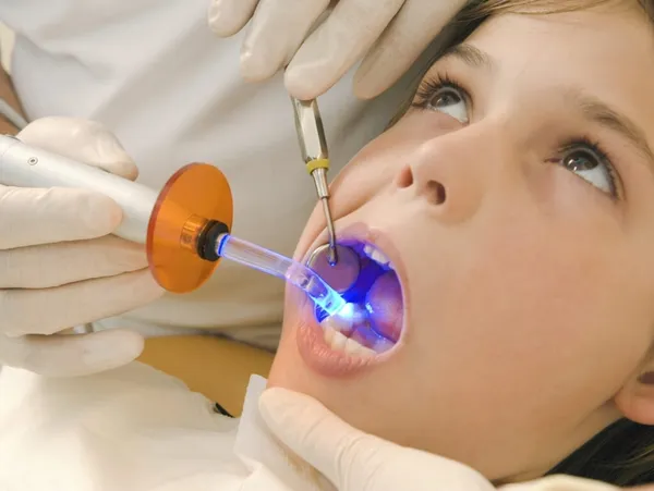 dental fillings