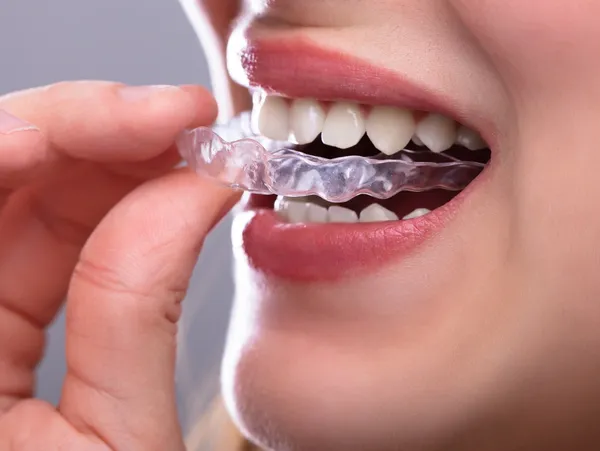 Invisible Clear Aligners