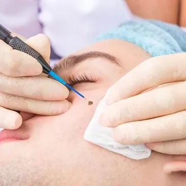 Mole/Skin Tag Removal