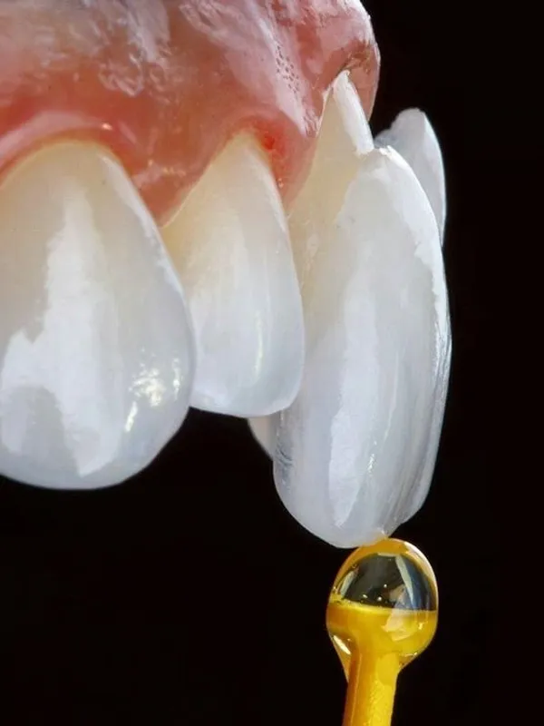 dental veneers